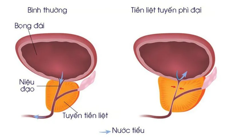 U xơ tiền liệt tuyến hay còn gọi là phì đại tiền liệt tuyến là chứng bệnh thường gặp ở nam giới đặc biệt là sau 40 tuổi 