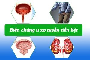 U xơ tiền liệt tuyến có thể dẫn đến nhiều biến chứng nguy hiểm đến sức khỏe mà bạn tuyệt đối không nên chủ quan