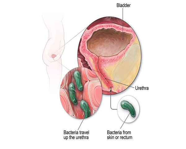 Nhiễm trùng hệ tiết niệu