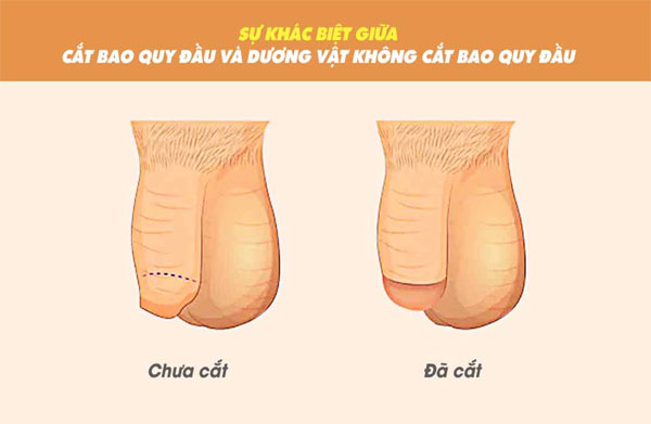 Hình ảnh tham khảo về cắt bao quy đầu