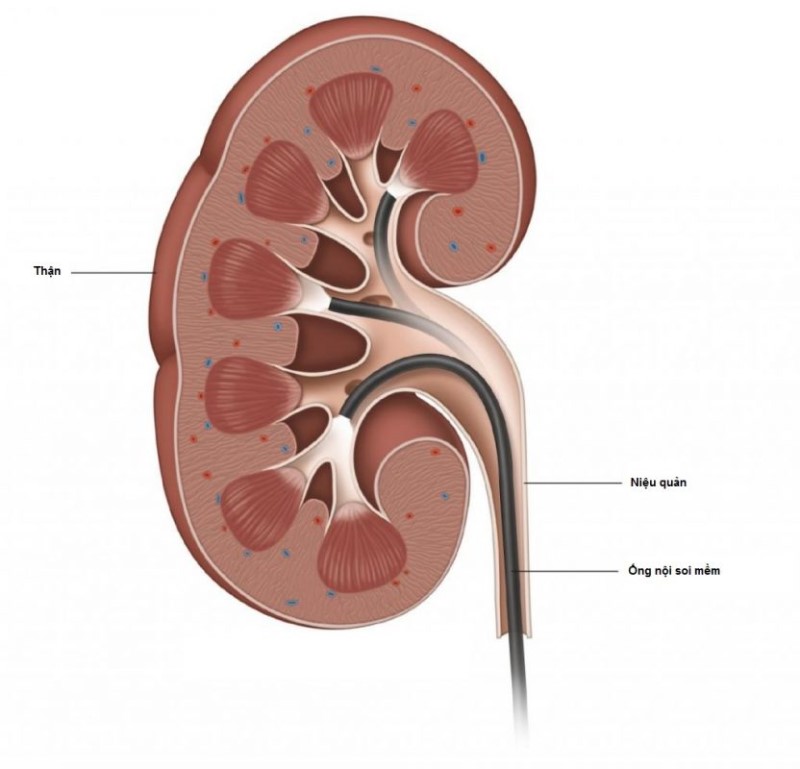 Tán sỏi thận bằng ống mềm được thực hiện như thế nào?