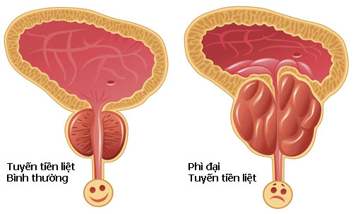 U xơ tiền liệt tuyến là căn bệnh thường gặp ở nam giới gây nhiều ảnh hưởng đến chất lượng cuộc sống 